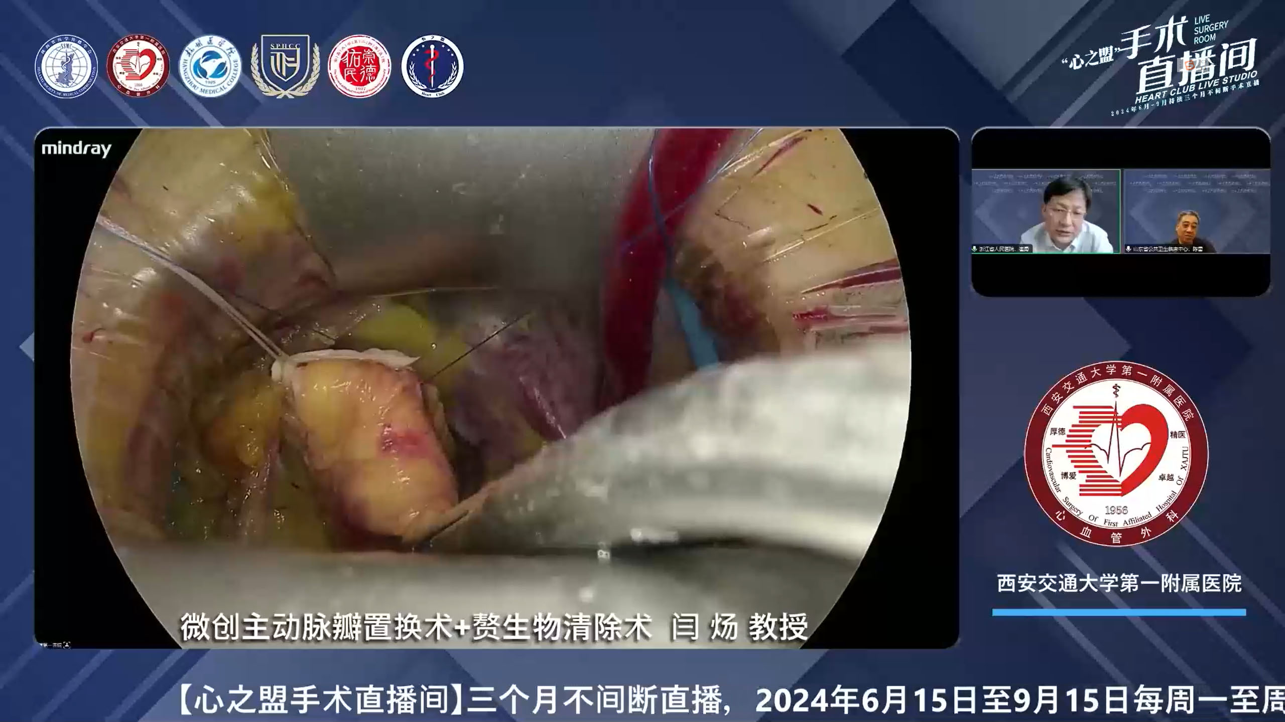 微创主动脉瓣置换+赘生物清除